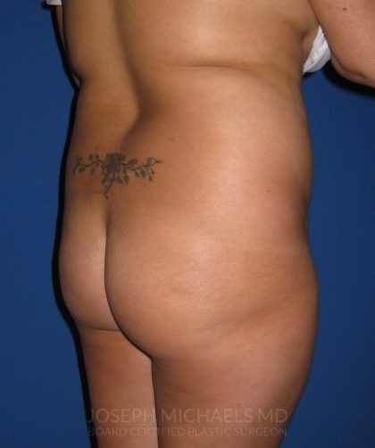 Buttock Augmentation Before & After Patient #4458